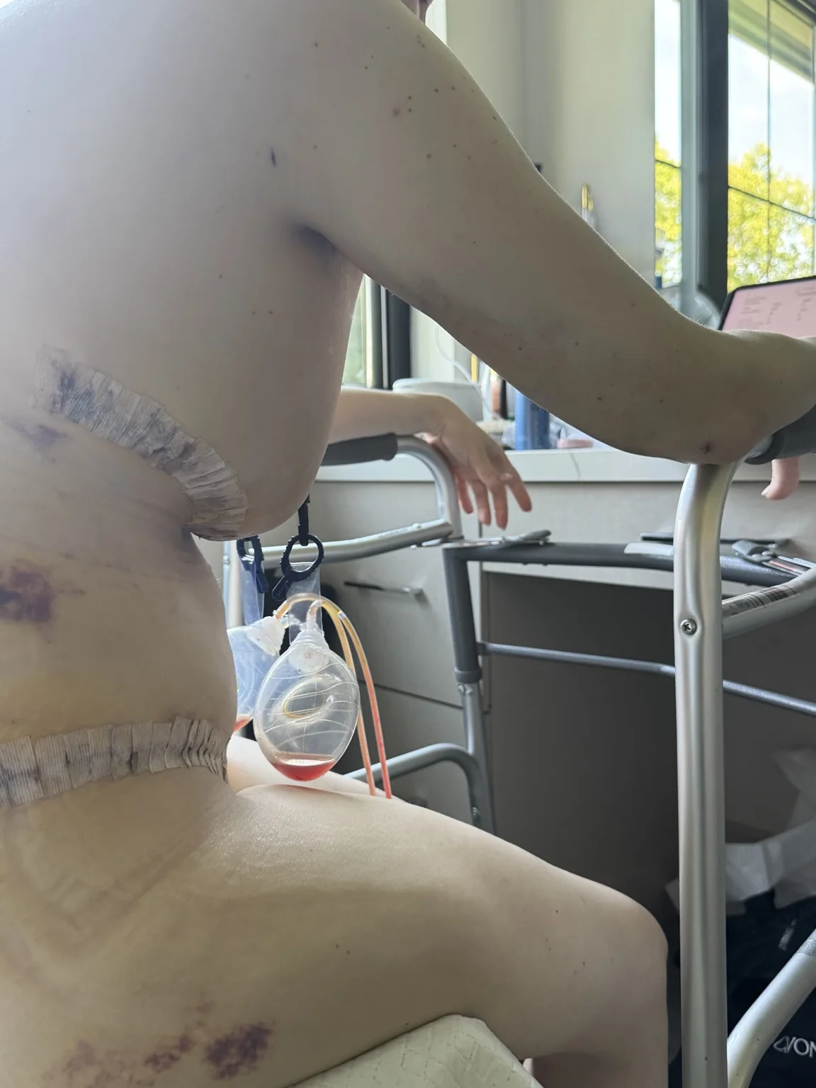 Post-operative mobility support